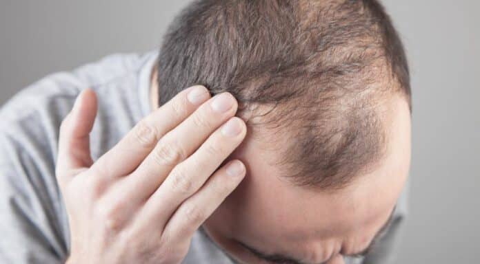 What Are Some Of The Causes Of Hair Loss?